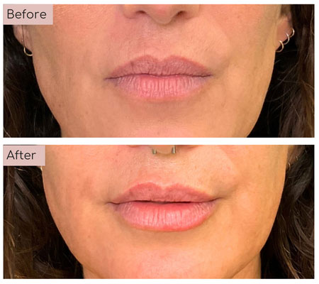 lip fillers before and afters